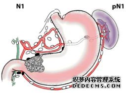 造成胆汁反流性胃炎的原因是什么