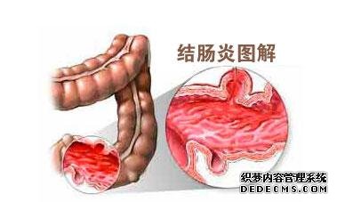 结肠炎患者会有哪些危害出现