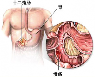 十二指肠溃疡